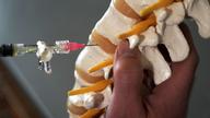 syringe is injected into disc