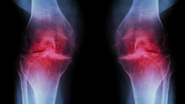 image of arthritic knee joints